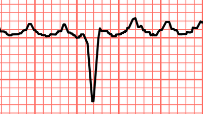 وش اسوي : رفرفة أذينية