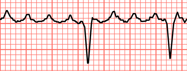 وش اسوي : رفرفة أذينية