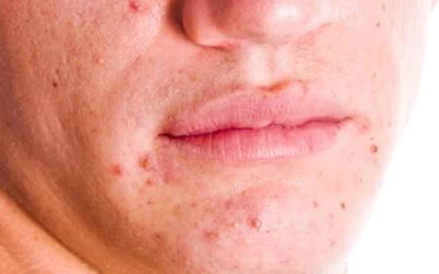 وش اسوي : حب الشباب