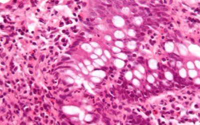 داء الأمعاء الالتهابي