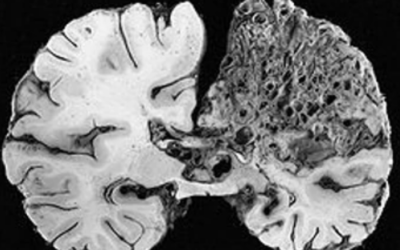 وش اسوي : تشوه شرياني وريدي