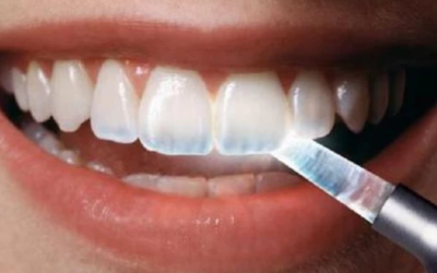 وش اسوي : ضعف طبقة المينا في الأسنان وطريقة علاجها