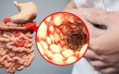 وش أسوي: مرض كرون