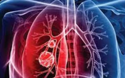 وش اسوي : ورم المتوسطة الخبيث