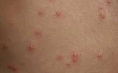 وش اسوي : جدري الماء