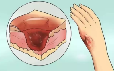 وش اسوي: الحروق الشديدة