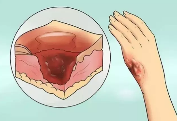 وش اسوي: الحروق الشديدة