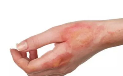 وش اسوي : درجات الحروق