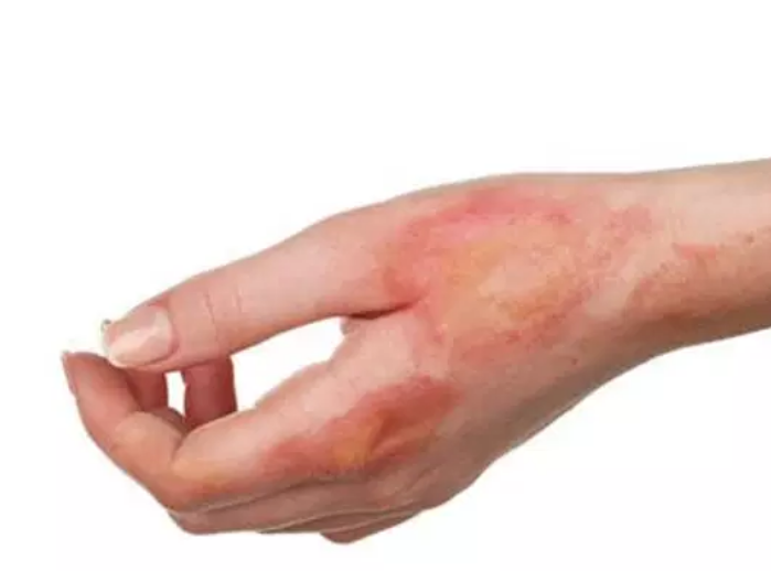 وش اسوي : درجات الحروق