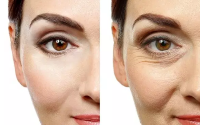 وش اسوي : طرق إزالة التجاعيد تحت العين