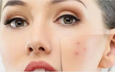 وش اسوي : حل مشكلة حبوب الوجه