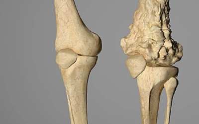 وش أسوي: سرطان العظام