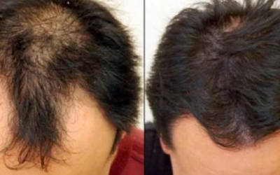 وش أسوي: علاج تساقط الشعر