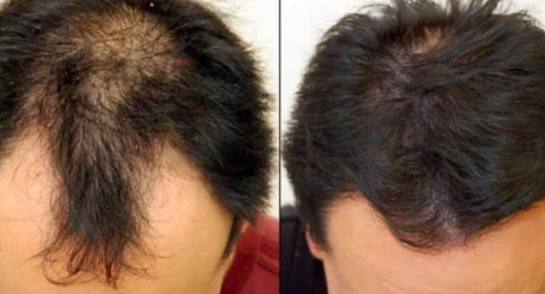 وش أسوي: علاج تساقط الشعر