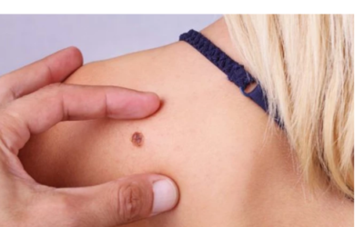 وش أسوي: جراحة الورم الميلانيني