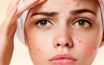 وش أسوي: حب الشباب