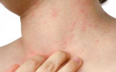 وش أسوي: الحساسية