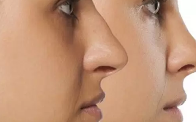 وش أسوي: الأنف المكسور