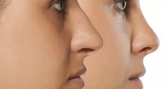 وش أسوي: الأنف المكسور