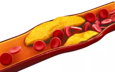 وش أسوي: ارتفاع الكوليسترول