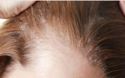 وش أسوي: الثعلبة (فروة الرأس)