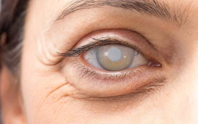 وش أسوي: جراحة اعتام عدسة العين