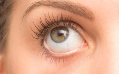 وش أسوي: أسباب وأعراض العيون الجافة