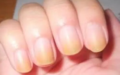وش اسوي : متلازمة الظفر الأصفر – Yellow nail syndrome
