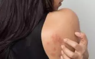 وش اسوي : مرض الشرى – Urticaria