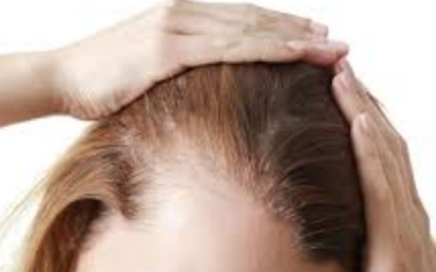 وش اسوي : سعفة الرأس – Tinea capitis