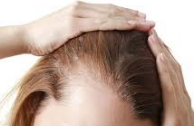 وش اسوي : سعفة الرأس – Tinea capitis