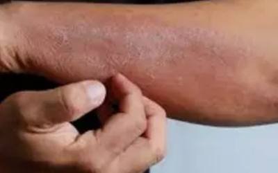 وش اسوي : علاج التهاب الجلد التأتبي