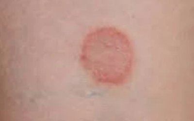 وش اسوي : ما هو الحزاز المسطح – Lichen planus؟