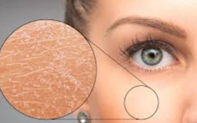 وش اسوي : ما هو مرض السماك – Ichthyosis؟