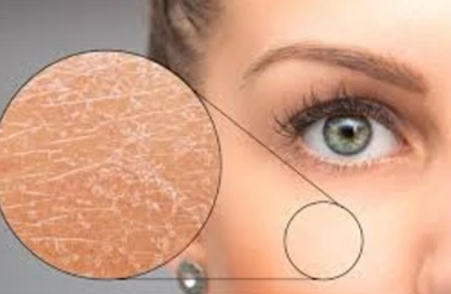 وش اسوي : ما هو مرض السماك – Ichthyosis؟