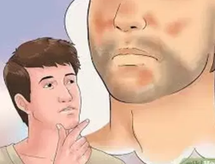 وش اسوي : التهاب الجلد الدهني – Seborrheic dermatitis