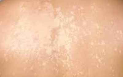 وش اسوي : النخالية المبرقشة – Pityriasis versicolor