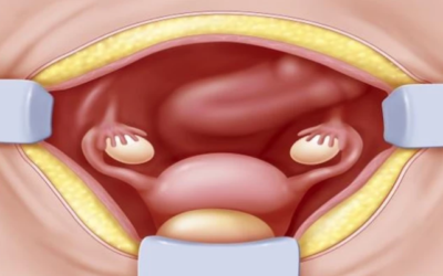 وش أسوي: هبوط المهبل الخلفي