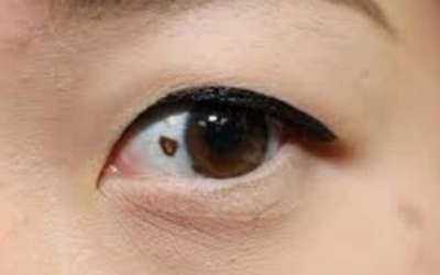 وش أسوي: ميلانوما العين