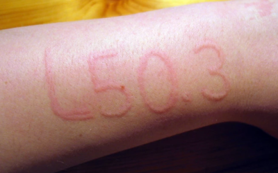 وش أسوي: كتوبية الجلد