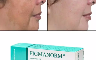 وش اسوي : كريم بيجمانورم للوجه والكلف المنطقة الحساسة