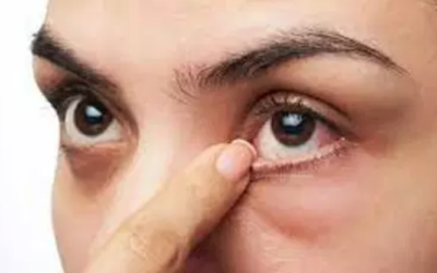 وش اسوي : علاج انتفاخ تحت العين طبيعيًا وطبيًا