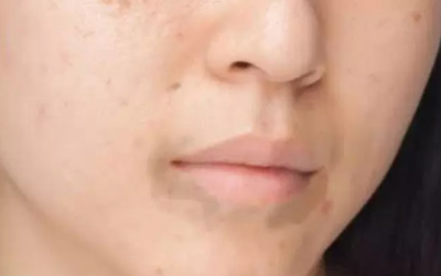 وش اسوي : علاج السواد حول الفم في المنزل