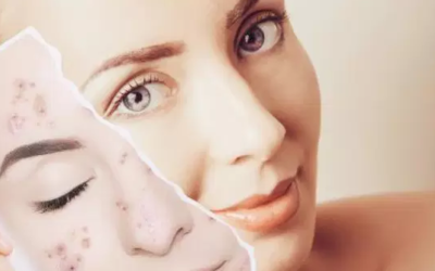 وش اسوي : إزالة آثار الحبوب أكثر الطرق الفعالة والمجربة