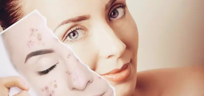 وش اسوي : إزالة آثار الحبوب أكثر الطرق الفعالة والمجربة