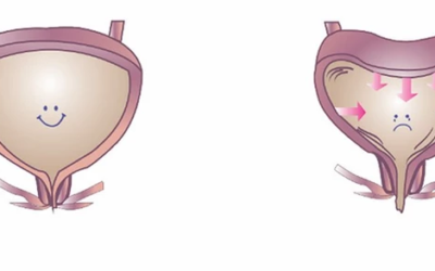 وش أسوي: فرط نشاط المثانة