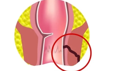 وش أسوي: فرط أوكسالات البول والداء الأوكسالي