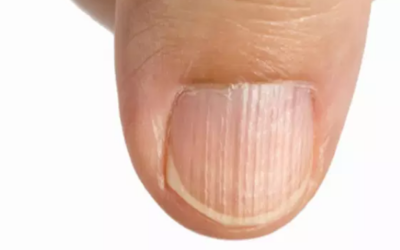 وش اسوي : ظهور خطوط على الأظافر