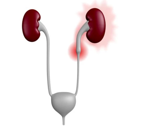 وش اسوي : ضيق الحالب