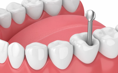 وش أسوي: دعامات الأسنان